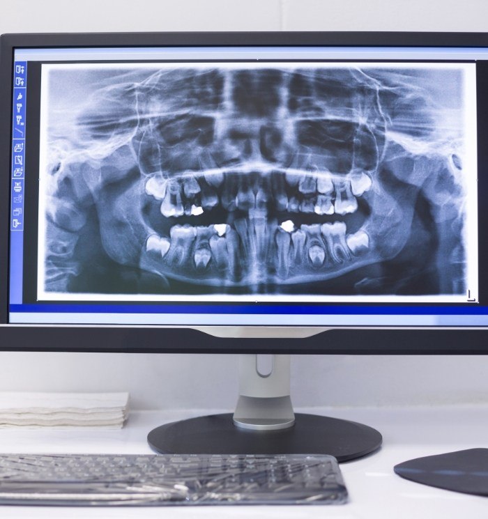 Computer screen showing digital dental x rays