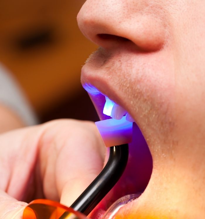 Close up of dental patient getting direct bonding