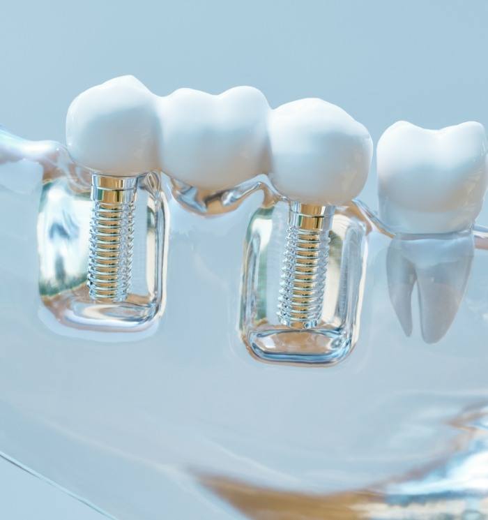 Model of two dental implants in the lower jaw