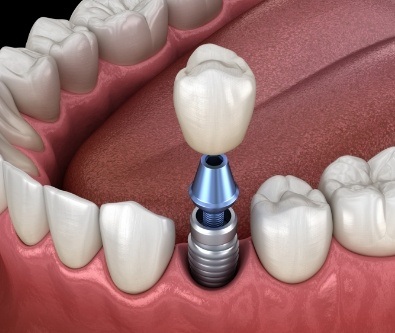 Animated dental implant with dental crown