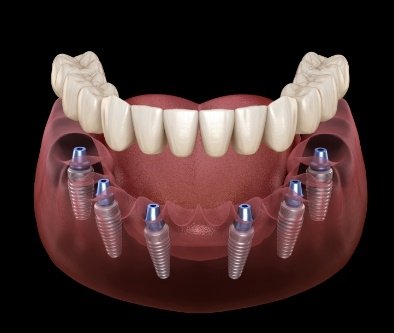 Animated six dental implants with full implant denture