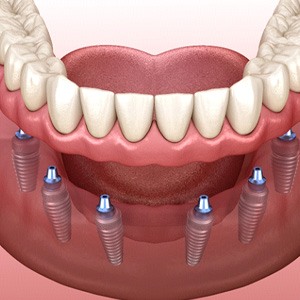 3D implant dentures on a set of dentures