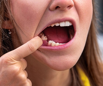 a close-up of a patient with a missing tooth
