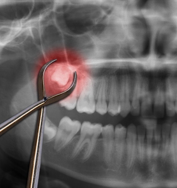 Dental X ray with impacted wisdom tooth highlighted red