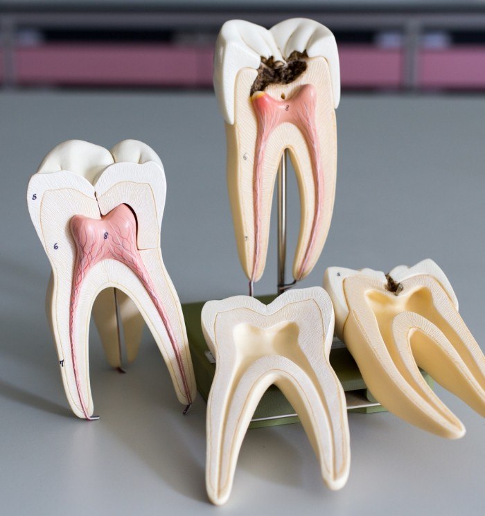 Models of damaged teeth that need root canal treatment
