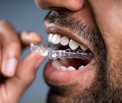 Up-close image of man inserting SureSmile aligner