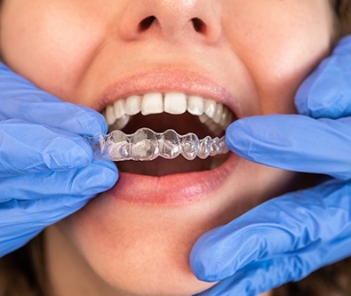 Up-close view of dentist inserting SureSmile aligner