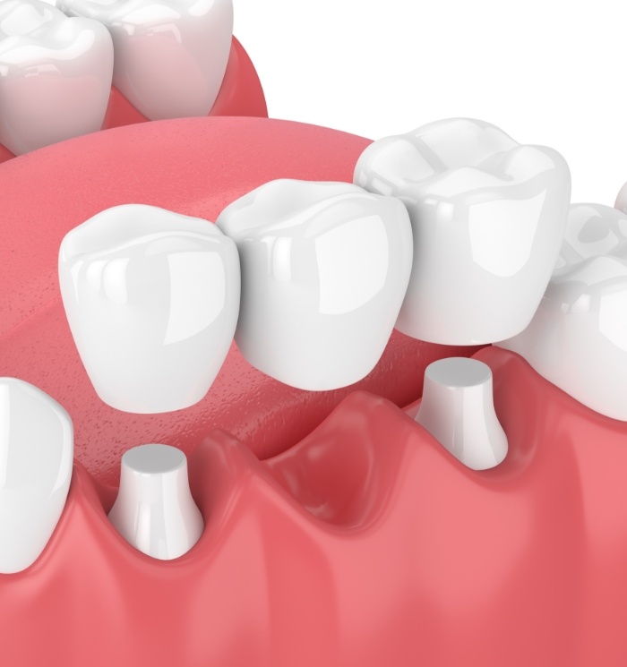 Animated dental bridge replacing a missing tooth