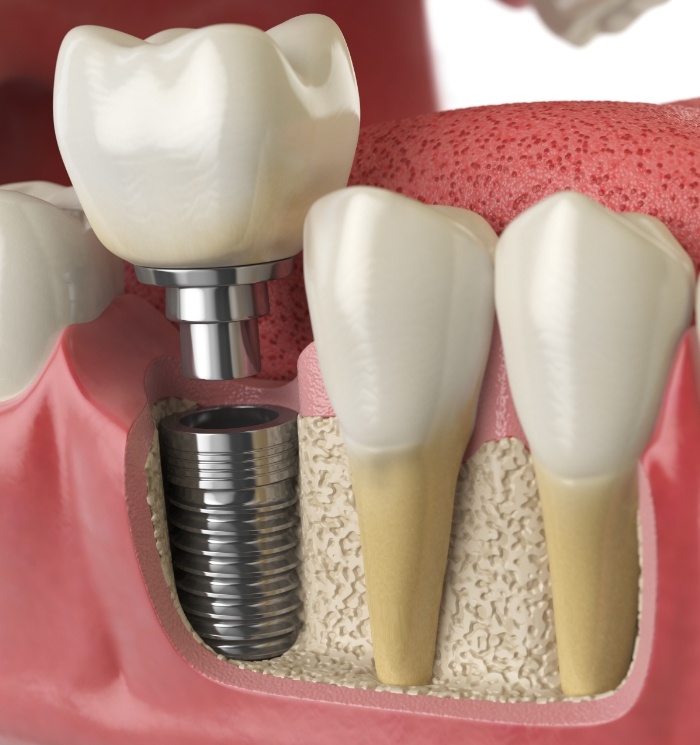 Animated dental implant with dental crown replacing a missing tooth