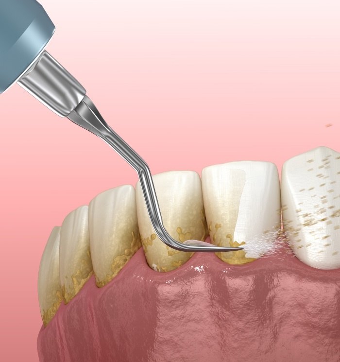 Animated dental tool removing plaque from teeth and gums