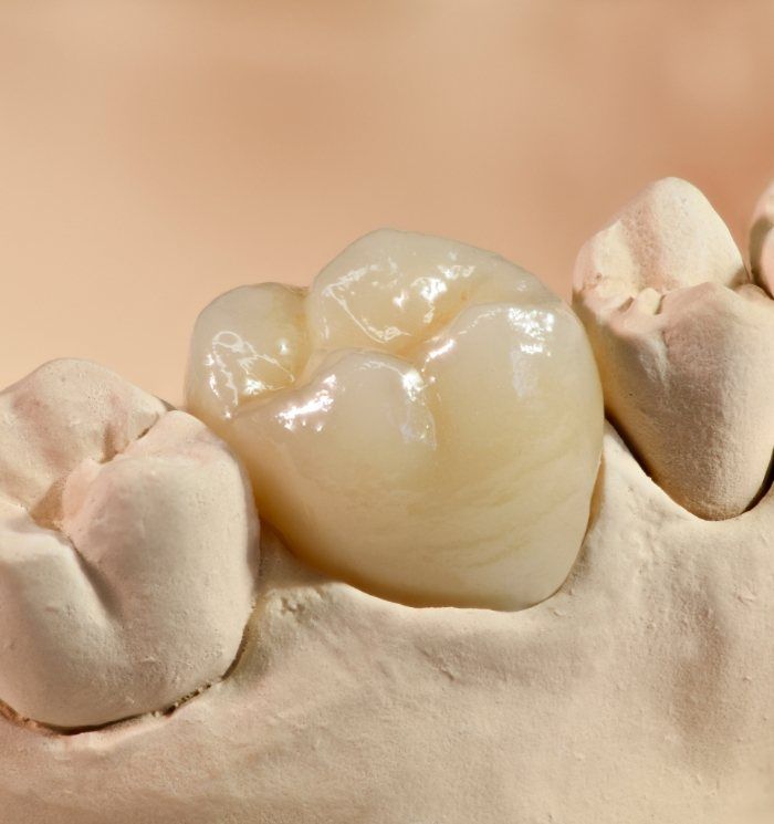 Dental crown over a tooth in model of mouth
