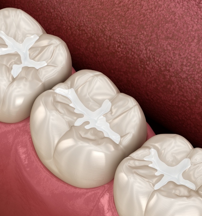 Animated row of teeth with tooth colored fillingd