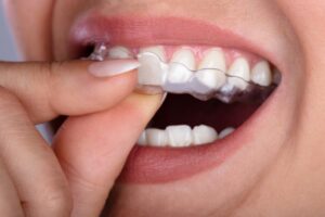 Clear aligner fitting over teeth.